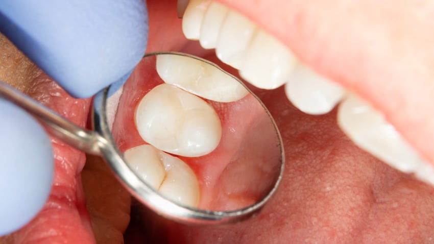 close up dental mirror in mouth