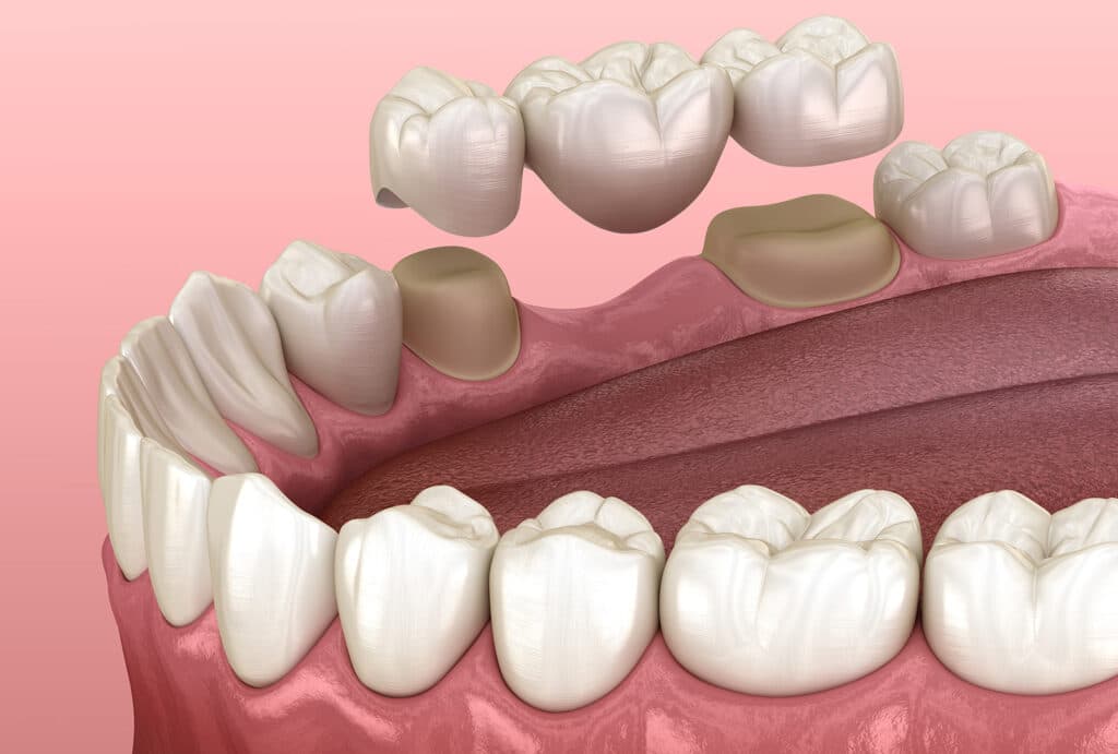 dental bridge