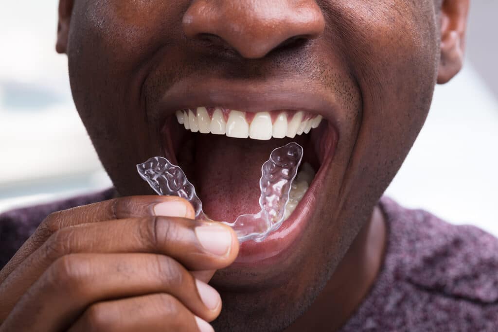 invisalign image